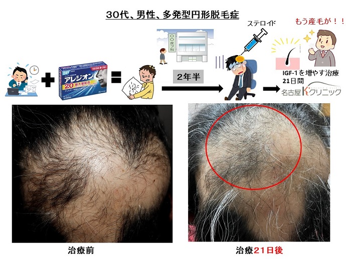 円形脱毛症　病院